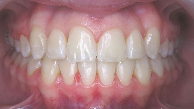Emilia's braces – after