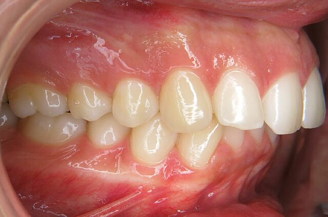 Nina´s Zahnspange Vorher 2