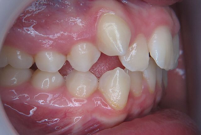 Emilia's braces – before