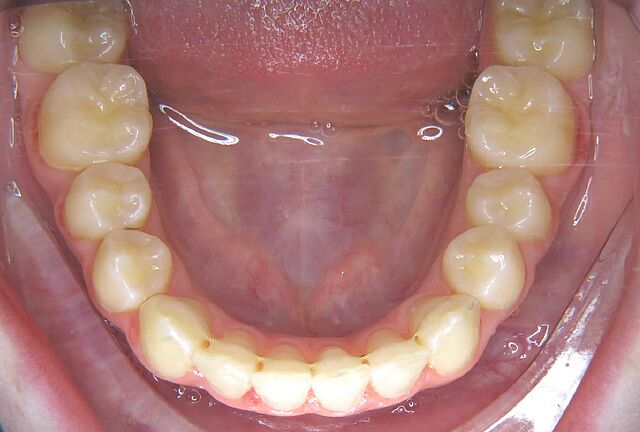 Emilia's braces – after