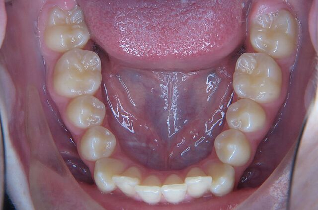 Emilia's braces – before