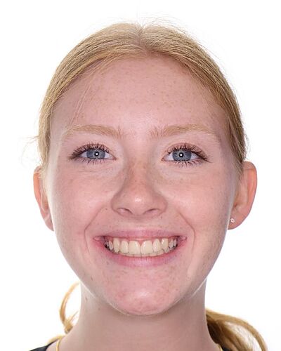 Emilia's braces