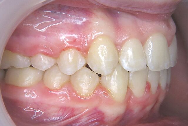 Emilia's braces – after