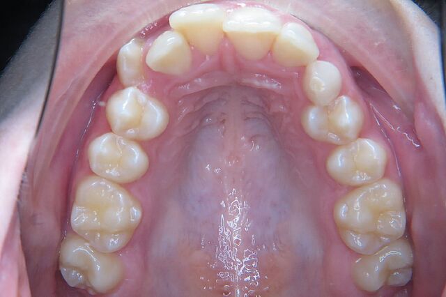 Emilia's braces – before