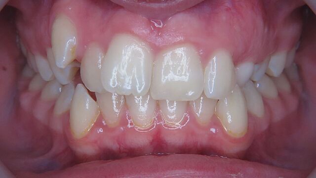 Emilia's braces – before