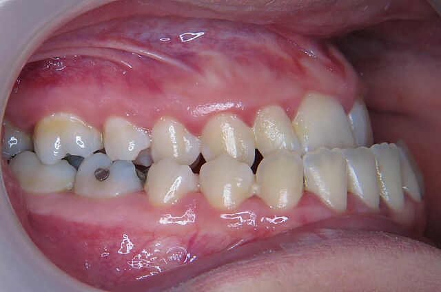 Verena`s Zahnspange Vorher 1