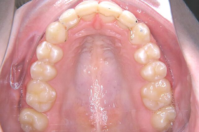 Emilia's braces – after