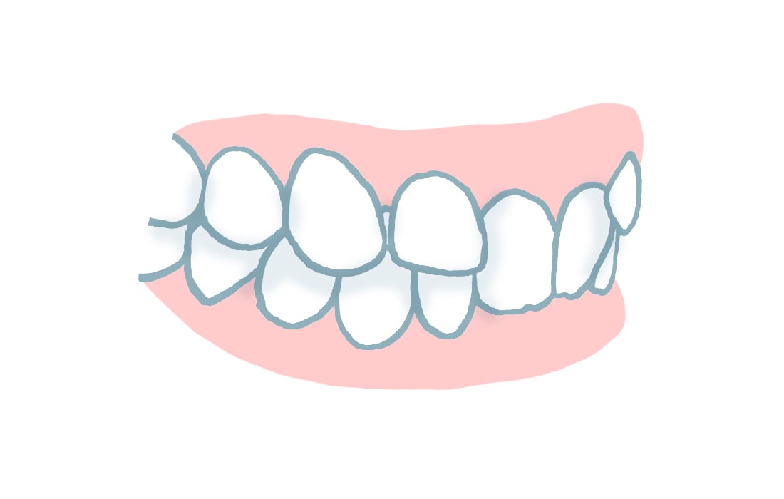 Zahnfehlstellung Deckbiss