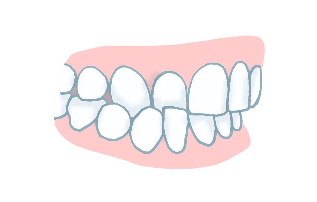 Zahnfehlstellung Kreuzbiss