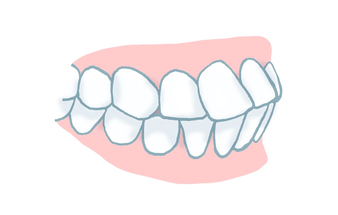 Zahnfehlstellung Protrusion