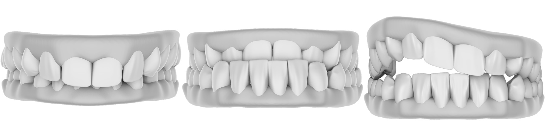 Zahnfehlstellungen für die Behandlung mit innenliegender Zahnspange