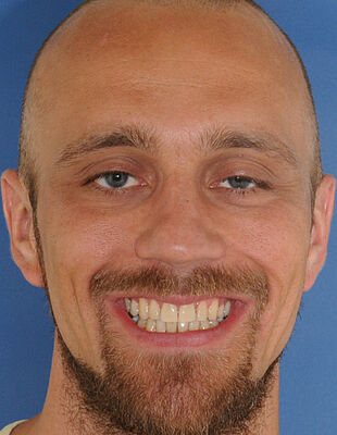 Unsichtbare Zahnspange - Nach der Behandlung mit Invisalign, Patient