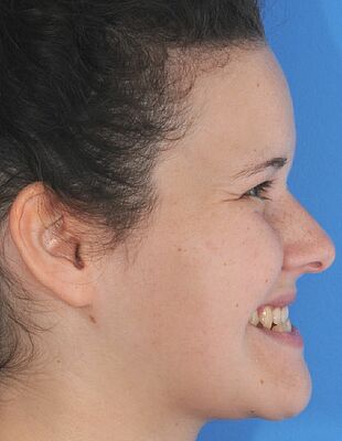 Unsichtbare Zahnspange - Vor der Behandlung mit Invisalign, Patient