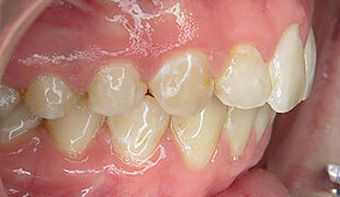 Unsichtbare Zahnspange - Nach der Behandlung mit Invisalign, Kiefer