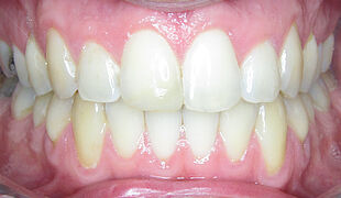 Unsichtbare Zahnspange - Nach der Behandlung mit Invisalign, Kiefer