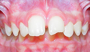 Unsichtbare Zahnspange - Vor der Behandlung mit Invisalign, Kiefer