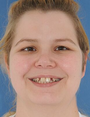 Unsichtbare Zahnspange - Vor der Behandlung mit Invisalign, Patient